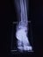 Film Ankle joint AP Case fracture distal metaphysis of distal tibia and fibula.Medical image concept.