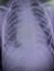 Film chest x ray with pleural effusion