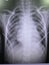 Film chest x ray show  right pleural effusion