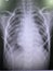 Film chest x ray show  right pleural effusion