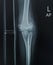 Film Elbow showing broken arm with humerus fracture .
