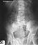 Film lumbo-sacral (LS) spines of a 62 years old man, antero-posterior (AP) view, demonstrated degenerative changes with