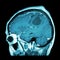 Film MRI of brain with brain tumor ( Sagittal plane , side view , lateral view ) ( Medical , Health care , Science Background )