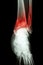Film x-ray ankle show fracture distal tibia and fibula (leg\'s bone)