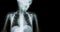 Film x-ray body of child and blank area at right side ( Medical background )