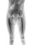 Film x-ray body of child & x28; Lower half of body & x29;