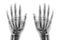 Film x-ray both hand AP show normal human hands on white background & x28; isolated & x29;