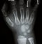 Film x-ray both hand AP : show normal human`s
