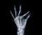 Film x-ray both hand AP view show  human's hands isolated  on black background