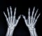 Film x-ray both hand AP view show  human's hands isolated  on black background