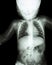 Film x-ray child\'s body ( normal baby )