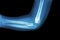 Film x-ray of child\'s elbow ( normal child\'s elbow ) ( Side view , Lateral )