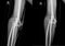 Film x-ray elbow AP-Lat