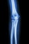 Film x-ray elbow AP : show normal human\'s elbow