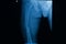 Film x-ray fracture right femur