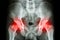 Film x-ray human\'s pelvis and arthritis at both hip joint (Gout , Rheumatoid)