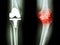 film x-ray knee of osteoarthritis knee patient and artificial joint