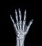 Film x-ray Left  Hand  AP view show  human's hands isolated  on black background