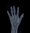 Film x-ray Left  Hand  AP view show  human's hands isolated  on black background