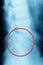 Film x-ray lumbar spine , L-S spine AP,Lateral view Grade spondylolithesis of L5-S1 , Decresed height of intervertebral disc space