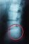 Film x-ray lumbar spine , L-S spine AP,Lateral view Grade spondylolithesis of L5-S1 , Decresed height of intervertebral disc space