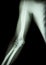 film x-ray of normal arm , elbow and forearm & x28;black background & x29;