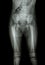 Film x-ray normal body of child (abdomen,buttock,thigh,knee)
