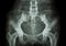 Film X-ray of Pelvis