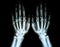 Film X-ray of Rheumatoid arthritis hand shows joint space narrowing of hand . Rheumatoid arthritis patient 's hand in x-ray.