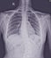 Film x-ray show spinal bend in teenager patient. Scoliosis disease.