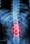 Film x-ray T-L spine(Thoracic-Lumbar spine) show : human\'s thoracic-lumbar spine and inflammation at lumbar spine