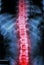 Film x-ray T-L spine(Thoracic-Lumbar spine) show : human\'s thoracic-lumbar spine and inflammation at spine