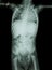 Film X-ray whole body of child ( Medical , Science and Healthcare concept )