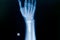 Film x-ray wrist fracture : show fracture distal radius