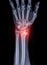 Film x-ray Wrist joint  showing fracture of ulnar bone  isolated  on black background