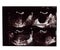 The Film Ultrasound, ovarian cysts,Internal organs examination for women
