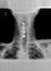 Film xray or radiograph of a cervical neck. AP anterior posterior view showing surgical bracket to help stabilize the patients