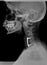 Film xray or radiograph of a cervical neck. Lateral side view showing surgical bracket to help stabilize the patients neck