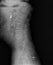 Film xray or radiograph of lumbar low back vertebrae showing facet joint syndrome of L4 L5 area which is an arthritis-like
