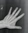 Film xray or radiograph of a normal left hand of an adult male. AP view show humans hand. normal bone structure of all phalanges