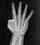 Film xray x-ray or radiograph of a hand and fingers showing the number four 4 in gestural language, manual communication, or