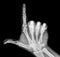 Film xray x-ray or radiograph of a thumb and finger in gestural language, manual communication, or signing aka sign language,