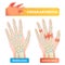 Finger arthritis vector illustration. Healthy and disease affected joints.