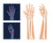 Finger arthritis vector illustration. Rheumatoid Arthritis hands x-ray. Pain in the human body. Arthritis, bone disease
