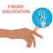 Finger Dislocation human medical organ vector illustratio.