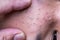 Finger on ugly pimples blackheads on face of teenager