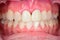 Fixed prosthetic crowns in central incisors.