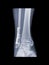 Fixed weber b fracture