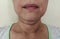 The flabbiness adipose and sagging skin under the neck, wrinkles and rough skin under the chin of the woman..