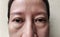 The Flabbiness adipose sagging and wrinkles and ptosis beside the eyelid